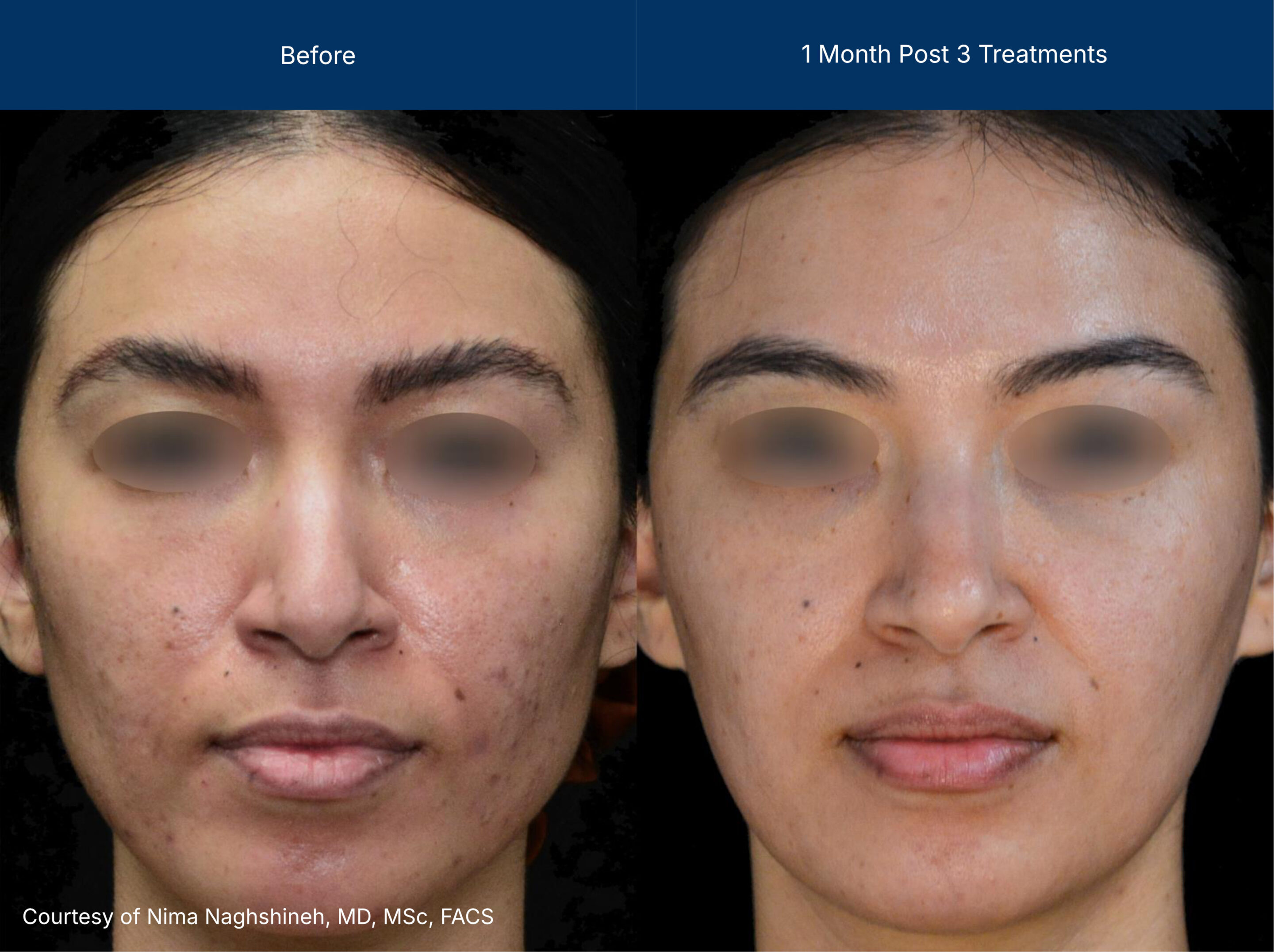 Superficial treatment Before and after photos of a female patient