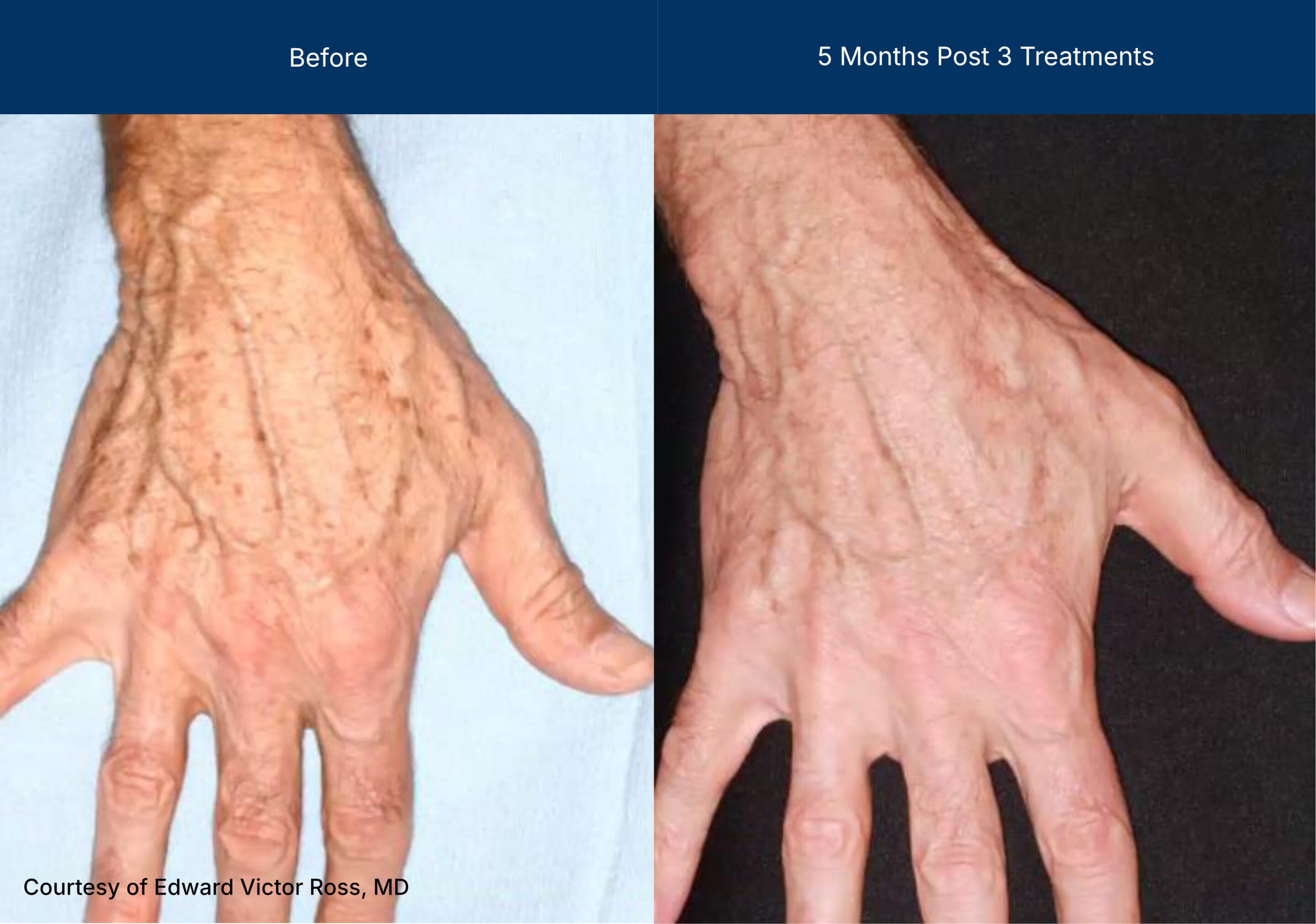 superficial treatment before and after photos of hand rejuvenation