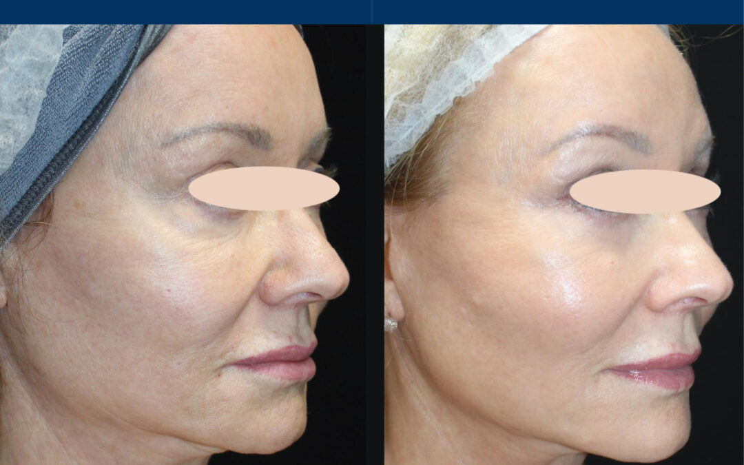 Moderate Treatment
