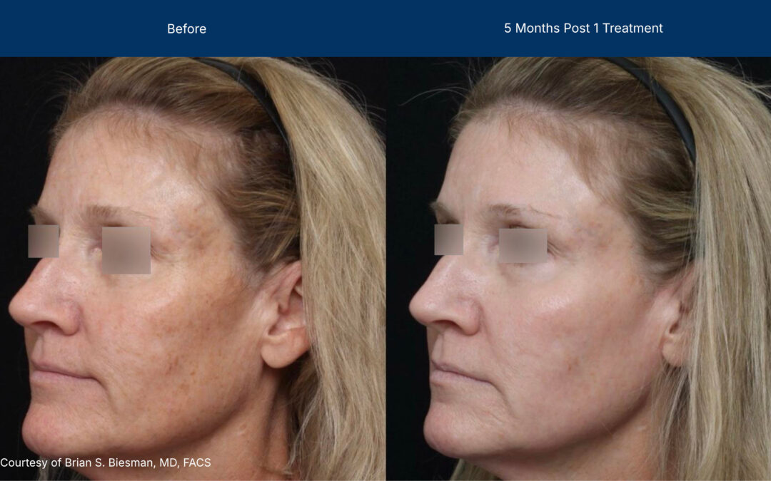 Advanced Treatment