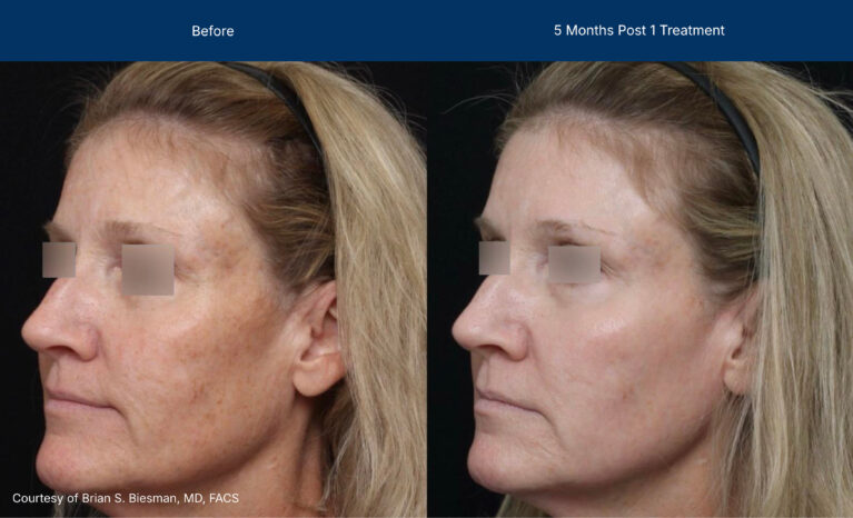 Ultraclear before and after photos