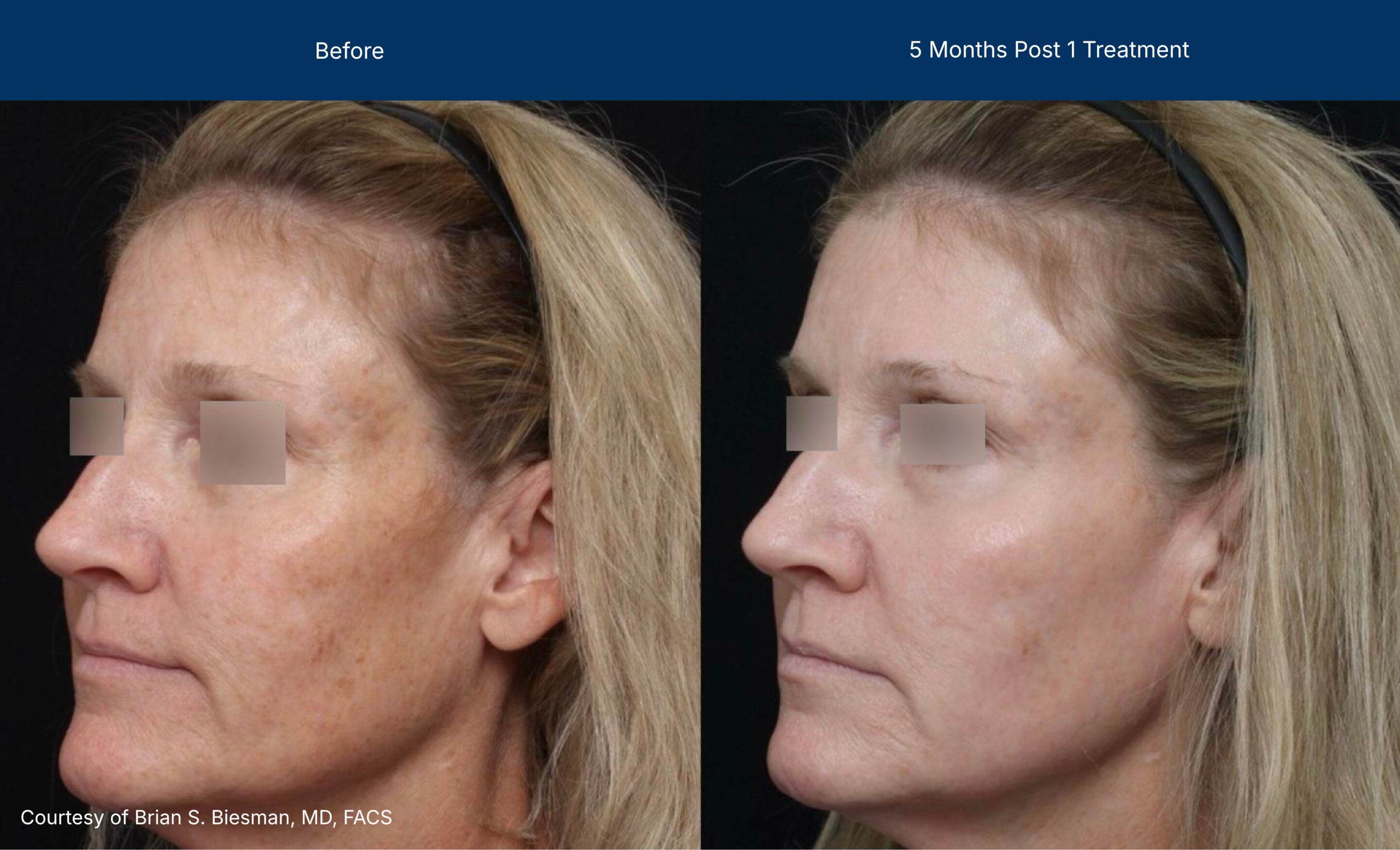 Ultraclear before and after photos