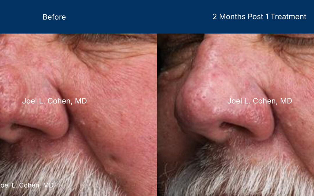Advanced Treatment with Laser-CoringTM & Full Ablation