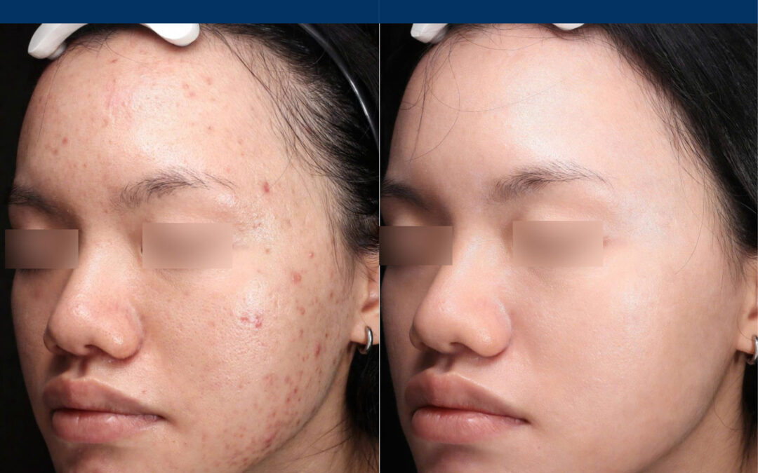 Moderate Treatment