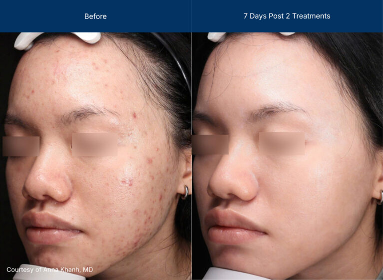 Moderate Treatment before and after photos of a female patient