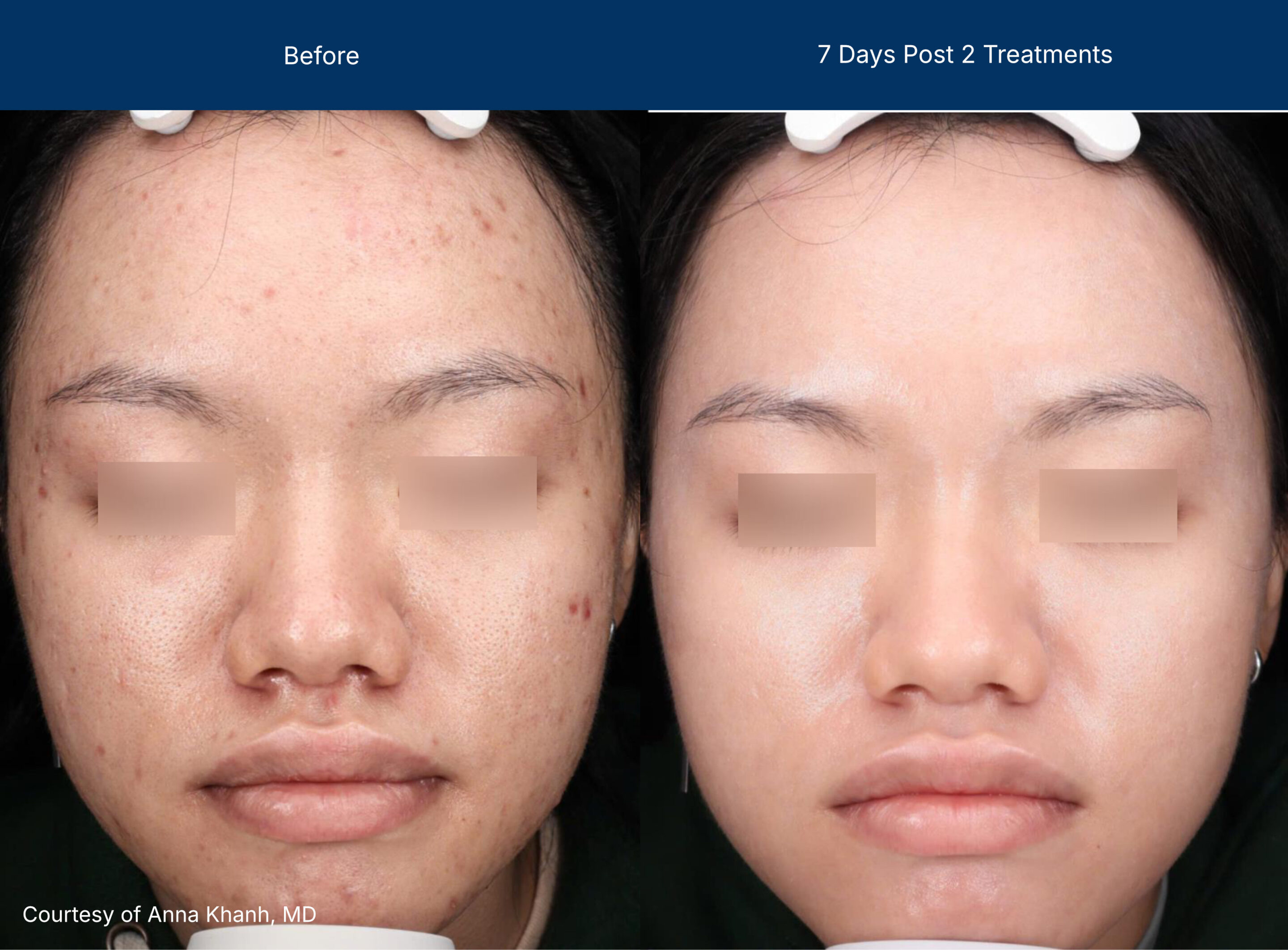 Moderate Treatment before and after photos of a female patient