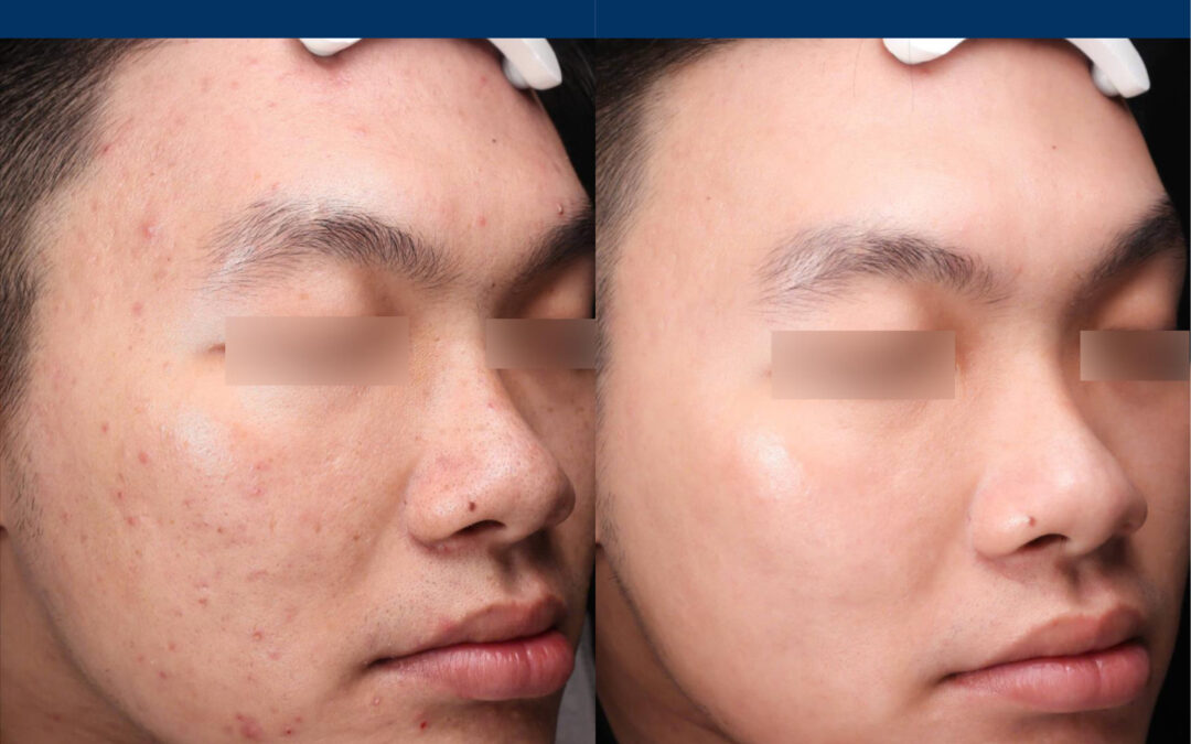 Moderate Treatment