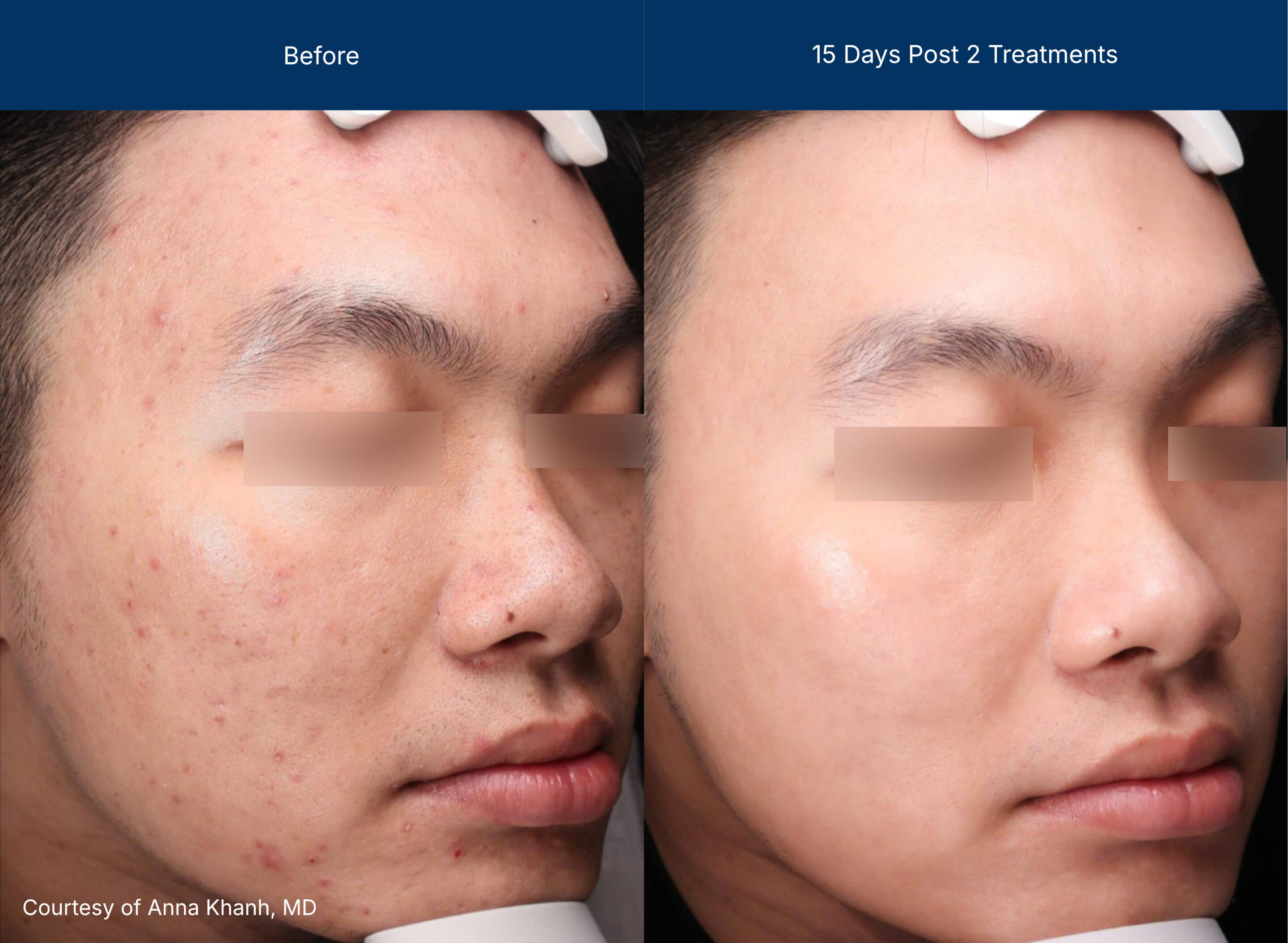 Moderate Treatment before and after photos of a male patient