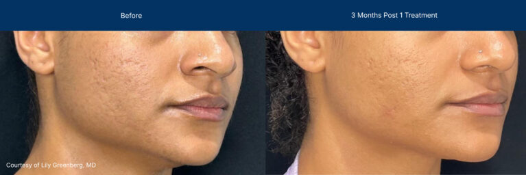 Moderate Treatment before and after photos of a female patient