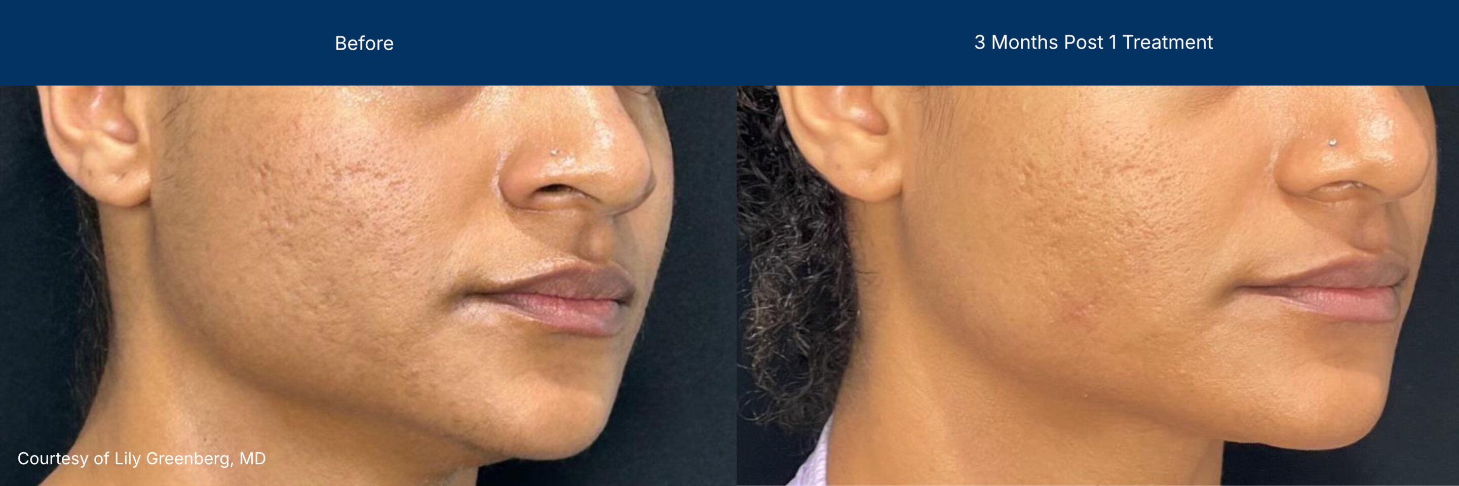 Moderate Treatment before and after photos of a female patient