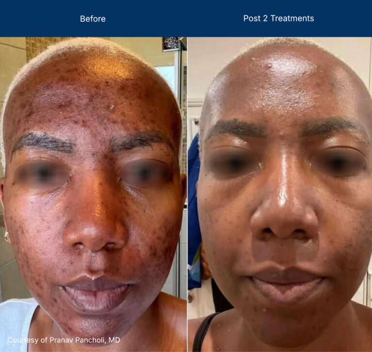 Moderate Treatment before and after photos of a female patient
