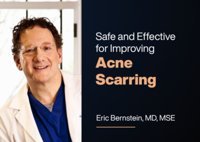 LSM Acne Scars